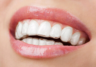 Clear Aligners