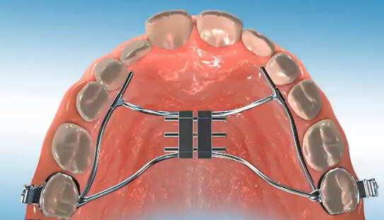 Palatal Expander