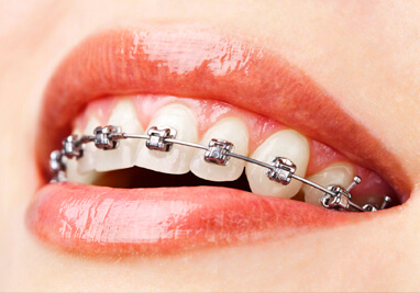 Traditional Silver Braces